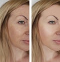 Face girl wrinkles before and after therapy cosmetic procedures Royalty Free Stock Photo