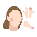 Face, hand and foot with frostbite symptoms, allergy or skin burn. Skin redness, erythema, hypothermia. Flat vector illustration