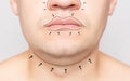 The face of a man marked with a marker before plastic surgery. Concept of facelift, rhinoplasty, double chin removal in plastic Royalty Free Stock Photo