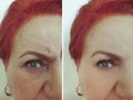 Face old woman removal wrinkles regeneration plastic   before and after treatment hydrating Royalty Free Stock Photo