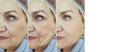 Face old woman wrinkles before  after cosmetology  arrow plastic correction mature tension rejuvenation treatment Royalty Free Stock Photo