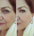 Face old woman removal wrinkles before and after treatment hydrating