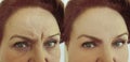 Face old woman removal wrinkles regeneration before and after treatment hydrating Royalty Free Stock Photo