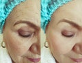 Face old woman removal wrinkles before correction after saggy therapy treatment