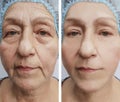 Face of an old woman wrinkles results treatment medicine before and after procedures