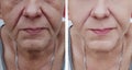 Face of an older woman regeneration before and after treatments