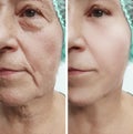Face of an old woman wrinkles results before and after procedures
