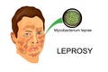 The face of the patient suffering from leprosy Royalty Free Stock Photo