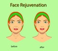 Face rejuvenation, vector illustration with before after effect