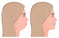 Face side view_Chin Augmentation 1 Royalty Free Stock Photo