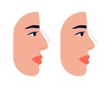 Face woman and correction of profile of nose, changing nasal shape during rhinoplasty surgery. Hump nose and straight