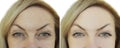 Face of woman`s wrinkle before and after e yes Royalty Free Stock Photo