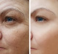 face woman wrinkles biorevitalization before and after procedures