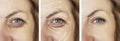 Face, woman, wrinkles, effect difference patient contrast correction before and after procedures, arrow Royalty Free Stock Photo