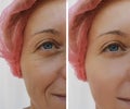 Face woman wrinkles patient dermatology before and after cosmetic anti-aging procedures