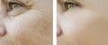 face woman wrinkles eyes before and after procedures, pigmentation Royalty Free Stock Photo