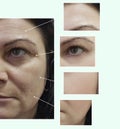 face woman wrinkles eyes therapy before and after procedures, pigmentation Royalty Free Stock Photo