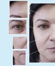 face woman wrinkles eyes therapy removal before and after procedures, pigmentation Royalty Free Stock Photo