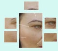 Face woman wrinkles eyes therapy treatment before and after procedures, pigmentation Royalty Free Stock Photo