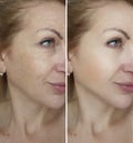 Face woman wrinkles before and after