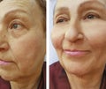 Face woman wrinkles before and after lifting cosmetology therapy Royalty Free Stock Photo