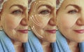 Face  woman wrinkles lifting difference    plastic therapy result before and after revitalization treatment Royalty Free Stock Photo