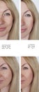 Face    woman  cosmetology correction removal wrinkles beautician lifting therapy before and after Royalty Free Stock Photo