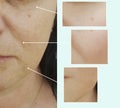 Face woman wrinkles therapy correction concept treatment before and after procedures, pigmentation Royalty Free Stock Photo