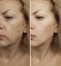 Face woman wrinkles before and after procedure revitalization