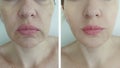 Face woman wrinkles saggy cosmetology removal difference before and after treatment