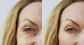 Face wrinkle woman before and after