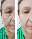 Face wrinkles elderly woman therapy plastic lifting before and after effect procedures Royalty Free Stock Photo