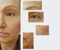 Face wrinkles elderly woman before and after removal, regeneration procedures Royalty Free Stock Photo