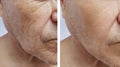 Facial elderly man patient forehead wrinkles injection antiaging effect medicine therapy face before and after procedures