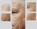 Facial elderly man patient forehead wrinkles effect medicine therapy face before and after procedures Royalty Free Stock Photo