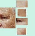 Facial elderly man patient forehead wrinkles antiaging effect medicine therapy face before and after procedures Royalty Free Stock Photo