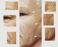 Facial elderly man patient forehead wrinkles hydrating effect medicine therapy face before and after procedures Royalty Free Stock Photo