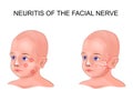 Facial nerve neuritis in a child Royalty Free Stock Photo