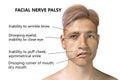 Facial nerve paralysis, Bell's palsy