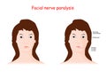 Facial nerve paralysis. Bell`s palsy