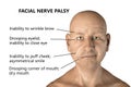 Facial nerve paralysis