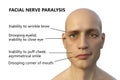 Facial nerve paralysis