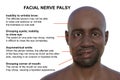 Facial palsy in an African man, 3D illustration highlighting the asymmetry and drooping of the facial muscles on one side of the