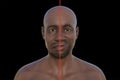 Facial palsy in an African man, 3D illustration highlighting the asymmetry and drooping of the facial muscles on one side of the