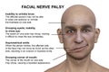 Facial palsy in a man, 3D illustration highlighting the asymmetry and drooping of the facial muscles on one side of the face