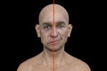 Facial palsy in a man, 3D illustration highlighting the asymmetry and drooping of the facial muscles on one side of the face