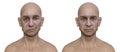 Facial palsy in a man and the same healthy man, 3D illustration showing the asymmetry and drooping of the facial muscles on one