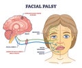 Facial palsy and muscles weakness because of nerve damage outline diagram Royalty Free Stock Photo