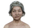 Facial palsy in a woman, 3D illustration highlighting the asymmetry and drooping of the facial muscles on one side of the face