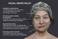 Facial palsy in a woman, 3D illustration highlighting the asymmetry and drooping of the facial muscles on one side of the face